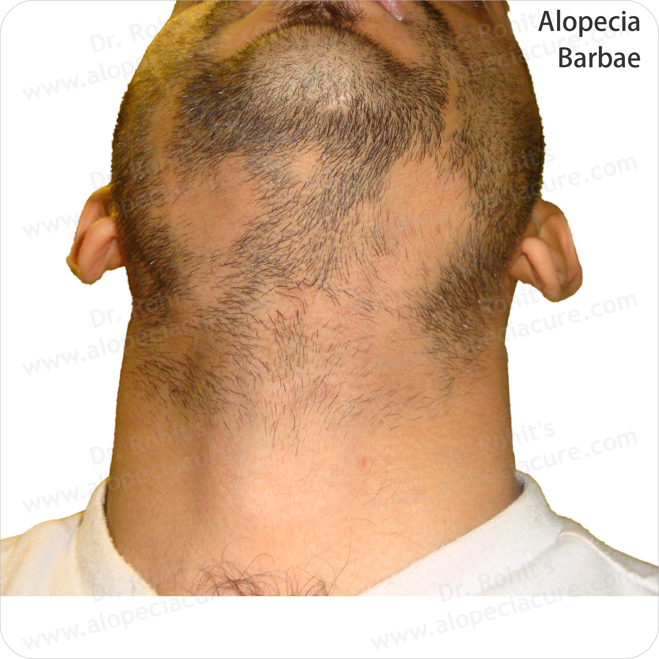 Alopecia Result